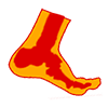 Metatarsalgie